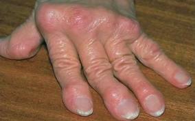 Ревматоидный артрит Ревматоидный артрит